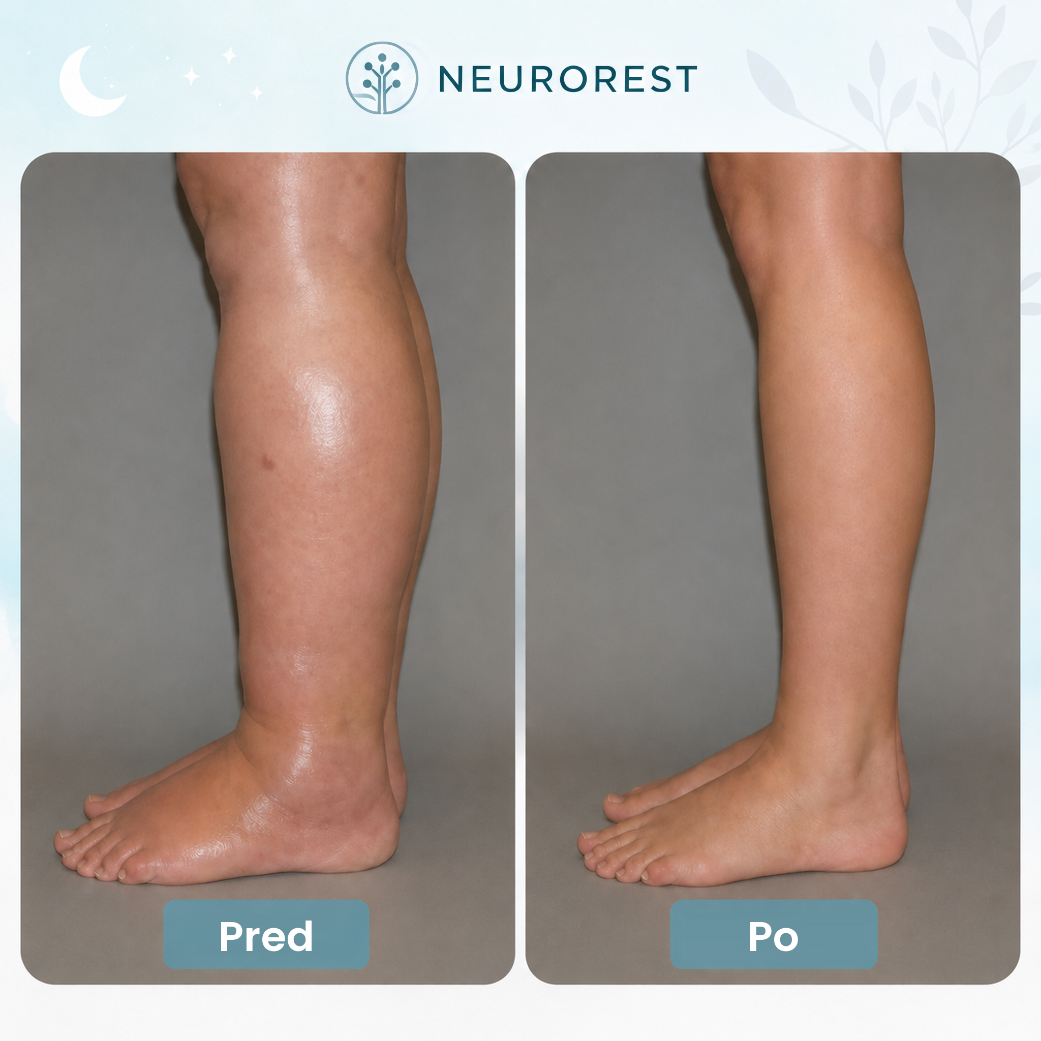 NeuroRest EMS aktivátor pre nohy